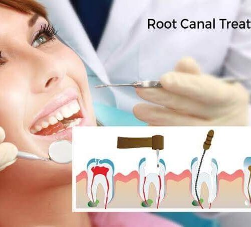 Root canal treatment procedure