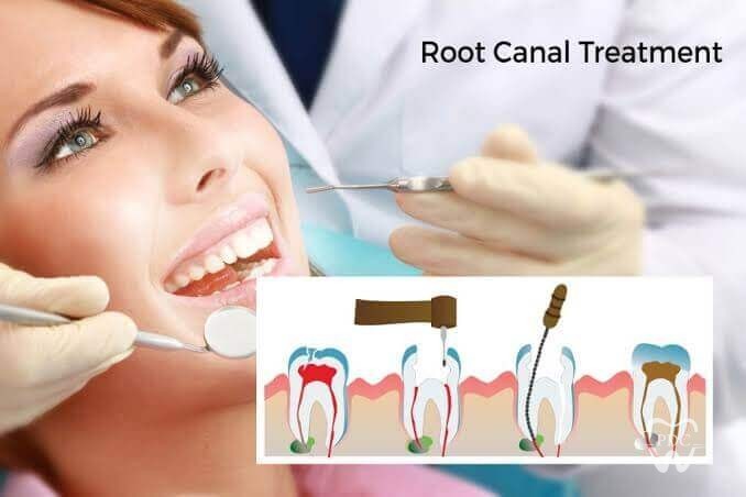 What is Root Canal Treatment?