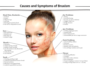 Causes and Symptoms of Bruxism