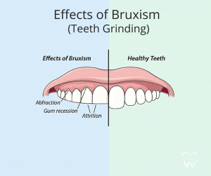 Effects of Bruxism