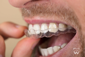 Bruxism treatment