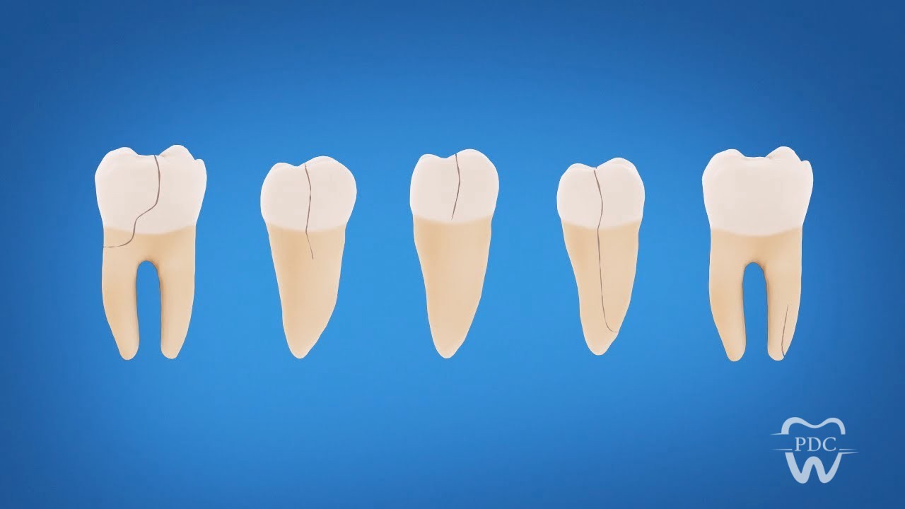 Types of Cracked Tooth