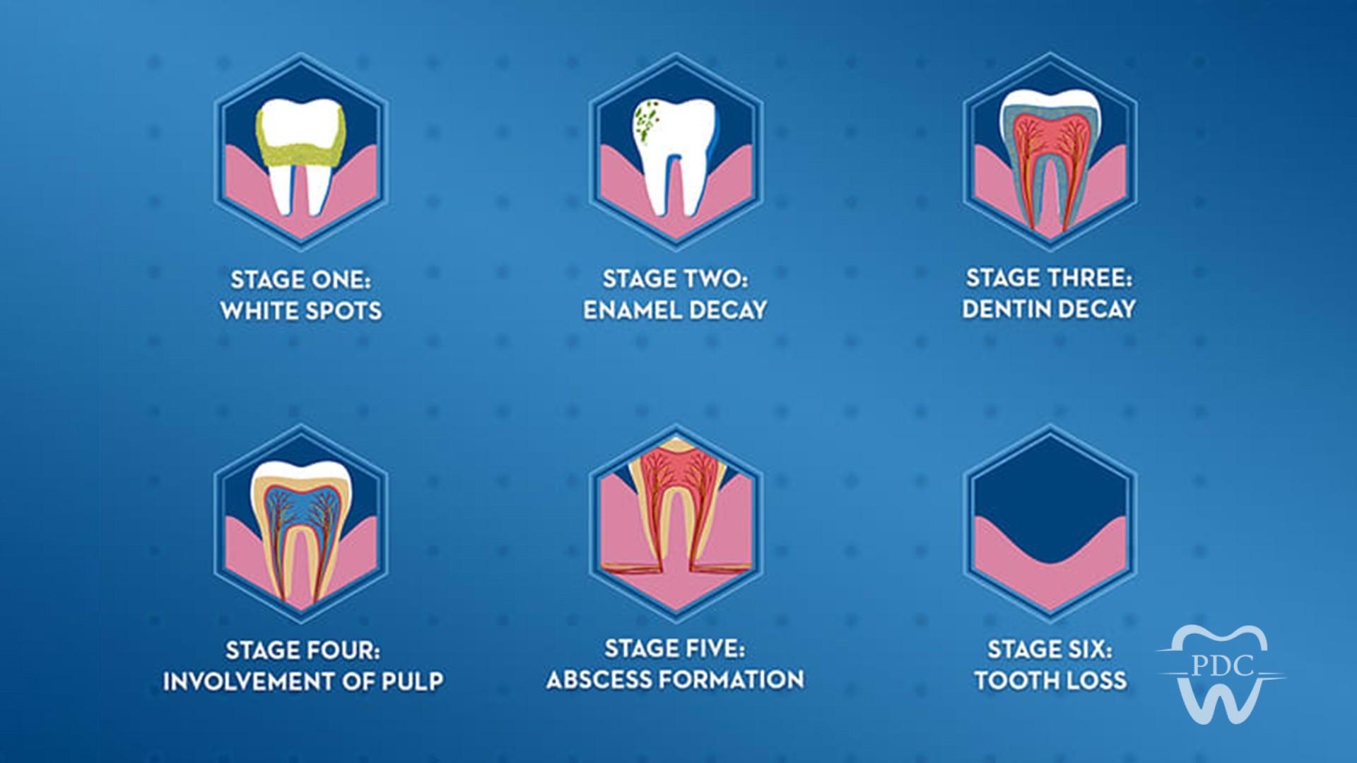 How to assess your risk for tooth decay