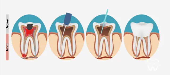 What to Expect During Your Root Canal Treatment? A Complete Patient Guide