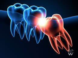 The Wisdom Tooth- To Save or Not to Save
