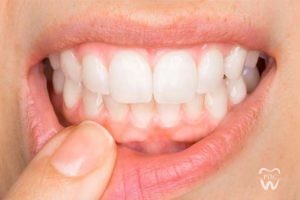 Healthy gums and oral hygiene