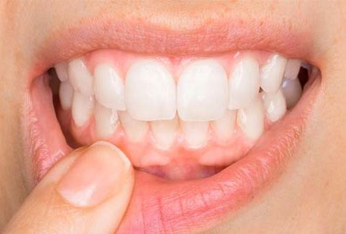 Healthy gums and oral hygiene