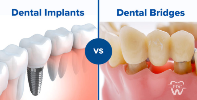 Dental Implant Vs Crown & Bridge: Finding What’s Best For You