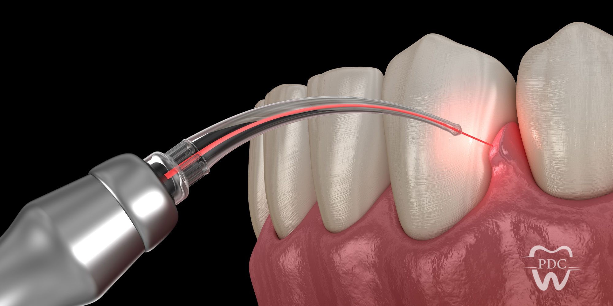 Lasers- How Is It Used In the Dental Clinic?