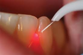 Dental Lasers – Asian Dental Academy