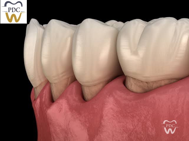 Are you Worried about Receding Gums?