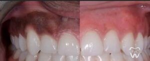 Gum disease symptoms and care