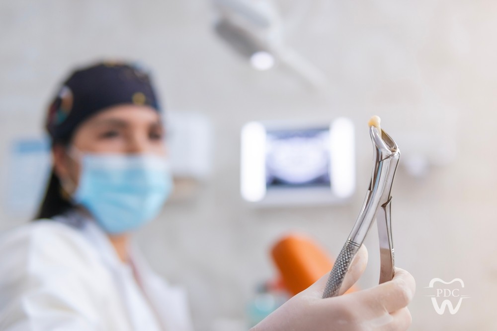 Myths about tooth extraction explained
