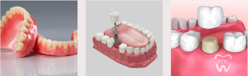 Dental implants