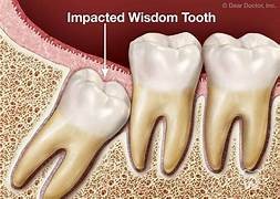 impacted wisdom teeth
