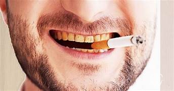 Effects of smoking on teeth and oral health