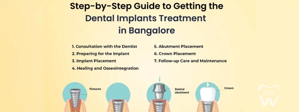 dental implants in Bangalore or HSR Layout
