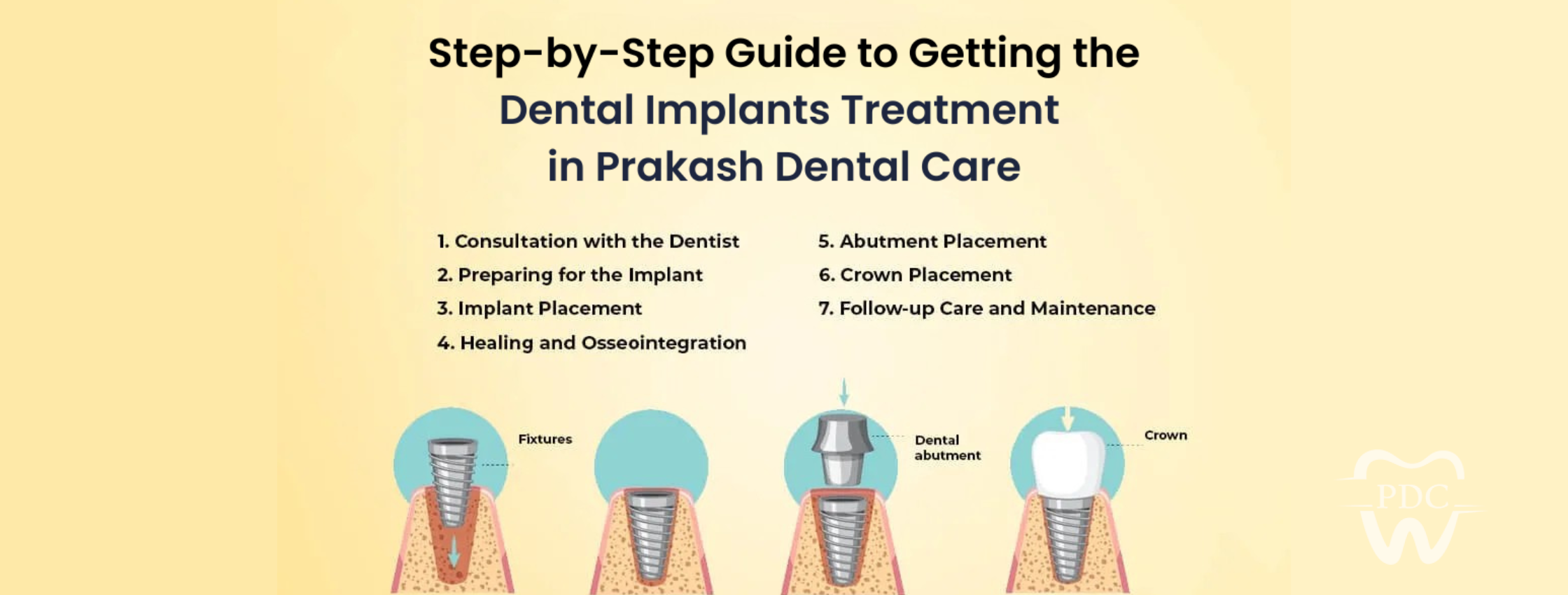 Step-by-Step Guide to the Dental Implant Procedure: From Extraction to Restoration
