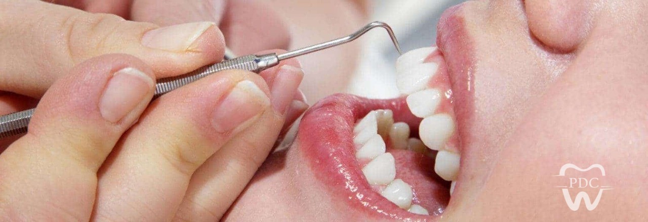 Tips for Keeping Your Teeth White After Whitening Treatment