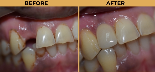 Best Dental Implants in HSR Layout