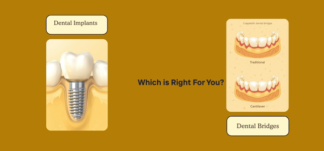 Dental Implants vs Bridges: Which Tooth Replacement Option Is Right for You?