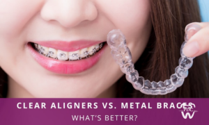 Invisible Aligners vs Traditional Braces