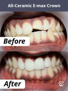 Crowns and Bridges Treatment in HSR Layout