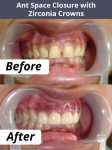  Crowns and Bridges Treatment in HSR Layout