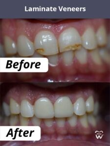 What Are Dental Veneers?