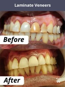 What Are Dental Veneers?