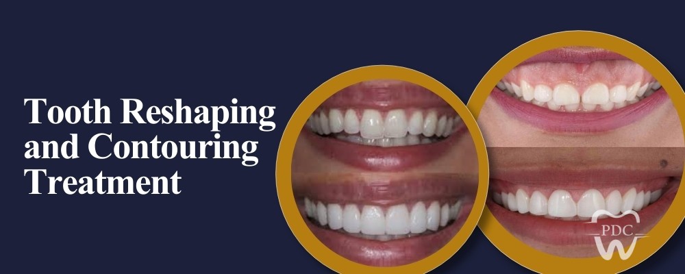 Tooth Reshaping and Contouring Treatment: Who Needs It & How It Works