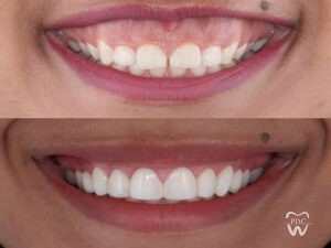 tooth reshaping and contouring treatment