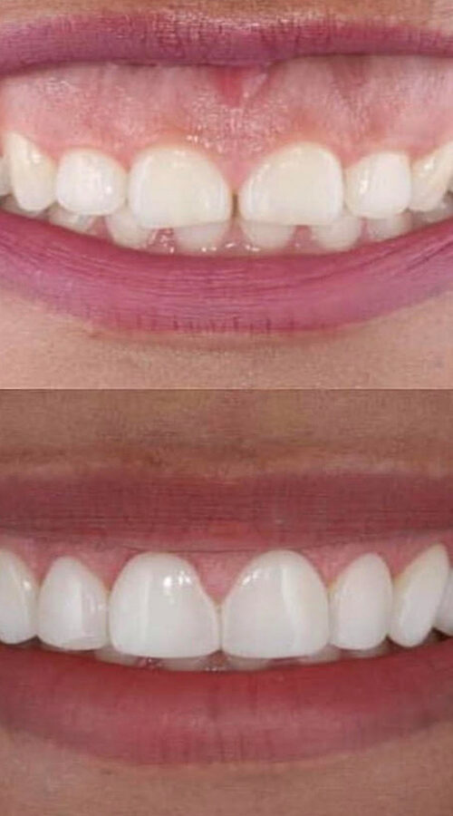tooth reshaping and contouring treatment