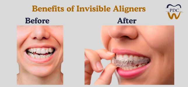 Invisalign Treatment in HSR Layout