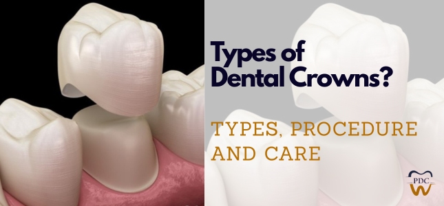 What are the Types of Dental Crowns? Types, Procedure and Care