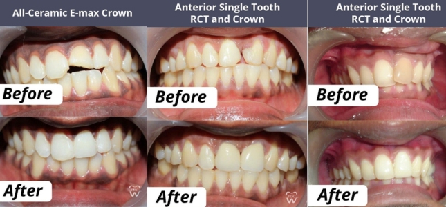 best clinic for Dental Crown & Bridges