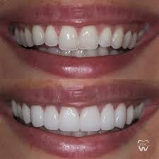 tooth reshaping and contouring treatment