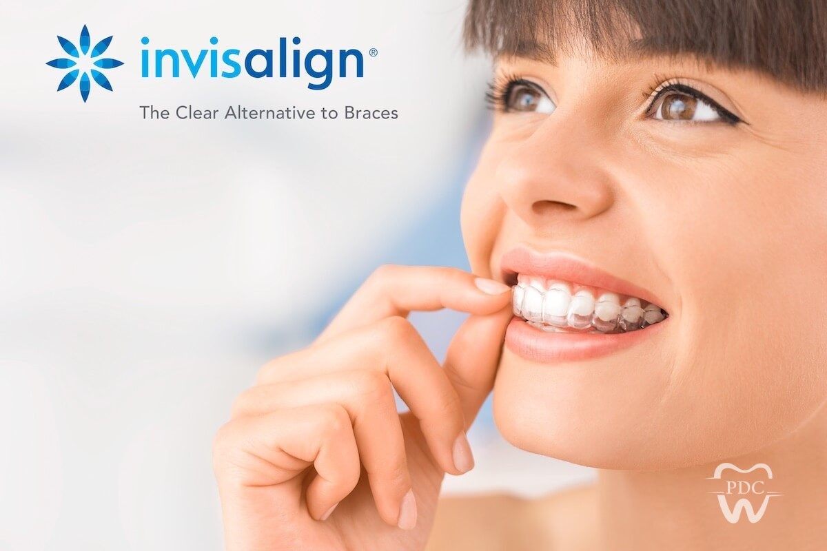 Aligners vs. Invisalign- Key differences explained