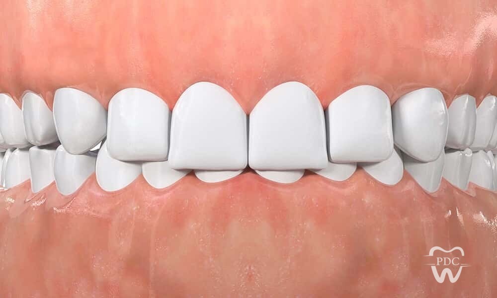 Is your bite biting you back?